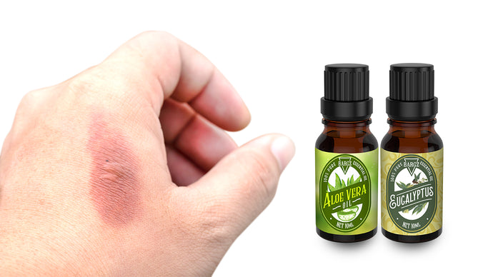 The Best Essential Oil For Burns: How To Use Eucalyptus & Aloe Vera Oil To Treat Minor Burns