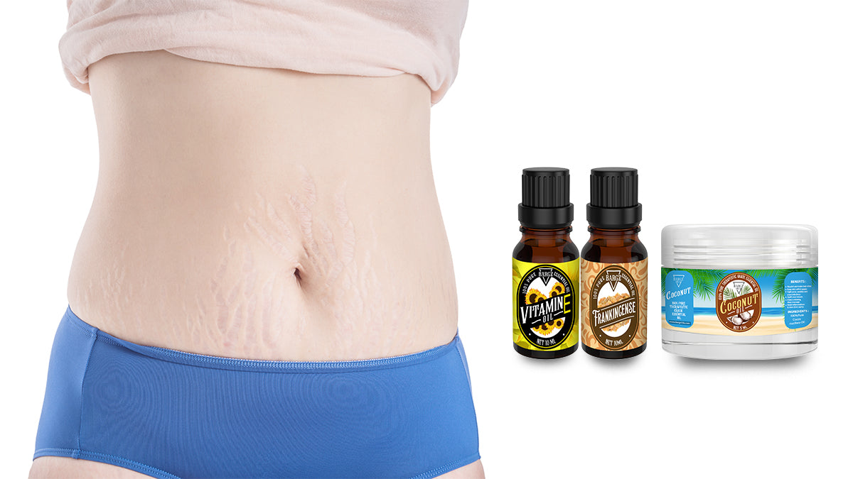 Read How to Use Frankincense Essential Oil for Stretch Marks